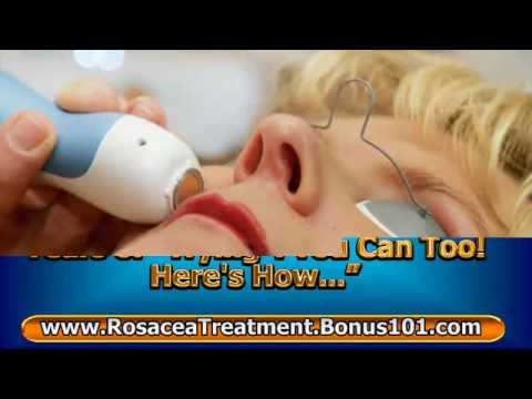 how to treat ocular rosacea