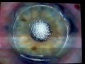 Is LASIK right for me?  Informative video of the procedure