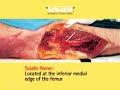 Traction Splinting 1
