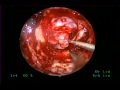 Endoscopic Endonasal Transsphenoidal Resection of Pituitary Adenoma-James K. Liu, MD