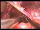 Hernia-Hiatal-sin-ma