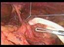 Hernia-Hiatal-sin-ma