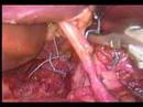 Hernia-Hiatal-sin-ma