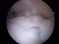 Operaci�n: Trasplante Osteocondral femur Rodilla Izquierda