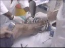 Part 2: External Fixation Removal _ Ilizarov to full leg cast Part 2: External Fixation Removal _ Ilizarov to full leg cast