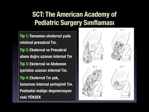 AĞUSTOS AYI OLGUSU / FETAL SAKROKOKSİGEAL TERATOM OLGULARINA YAKLAŞIM