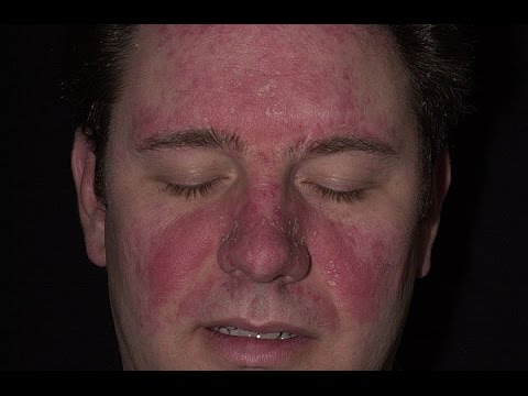 how to treat seborrheic dermatitis