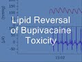 intralipid infusion is used to reverse a period of bupivacaine-induced cardiac arrest in a rat model. arterial pressure and ecg waveforms are shown.

visit http://www.lipidrescue.org for more information.