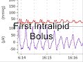 intralipid infusion is used to reverse a period of bupivacaine-induced cardiac arrest in a rat model. arterial pressure and ecg waveforms are shown.

visit http://www.lipidrescue.org for more information.