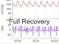 intralipid infusion is used to reverse a period of bupivacaine-induced cardiac arrest in a rat model. arterial pressure and ecg waveforms are shown.

visit http://www.lipidrescue.org for more information.