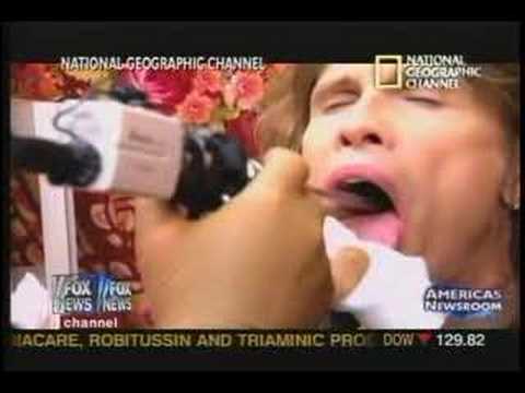 how to repair vocal chords