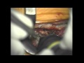 Use of Bone Scalpel - Hemilaminectomy
