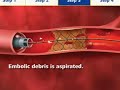 Proximal protection device & Coronary artery Lavage Proximal protection device & Coronary artery Lavage