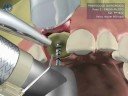 IMPLANTE DENTAL UNITARIO FASE QUIRURGICA