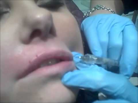 how to dissolve lip filler