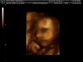 3D / 4D Ultrasound - DadThing.com
