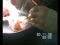 Heart Transplantation Heart Transplantation