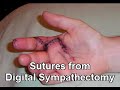 Narrated video slideshow of photos of systemic sclerosis (scleroderma) symptoms, including Raynaud's, digital ulcers, gangrene, digital sympathectomy, and sclerodactyly. Not all scleroderma patients have visible symptoms. Many have internal organ involvement that is much harder to detect. By Shelley Ensz for the nonprofit International Scleroderma Network at sclero.org.