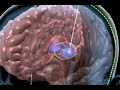 Deep-brain stimulation