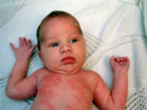 how to stop yourself from scratching eczema