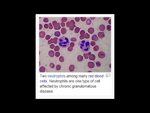 how to cure eosinophilic granuloma