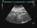 baby boy @ 23 weeks