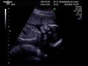 Unborn Baby yawns and drinks at ulrasound