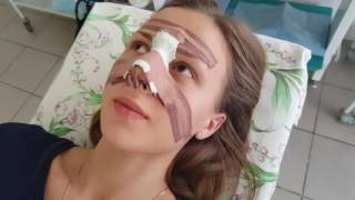Ринопластика своими глазами (снятие гипса)