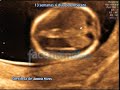 13 Semanas, 6 días de embarazo