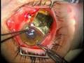 Finger's Amniotic Membrane Buffer Technique