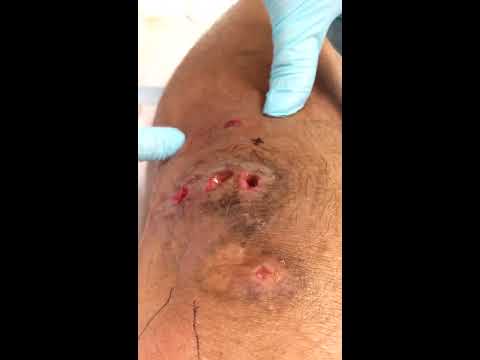 how to drain staph infection