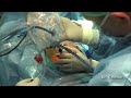 Artroscopia Hombro Luxacion.Dr. Galindo A & Dr. G. Martens