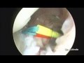Artroscopia Hombro Luxacion.Dr. Galindo A & Dr. G. Martens