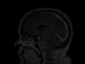Cerebral Cavernous Malformation Cavernous Malformation