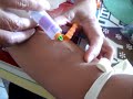 Venipuncture Venipuncture