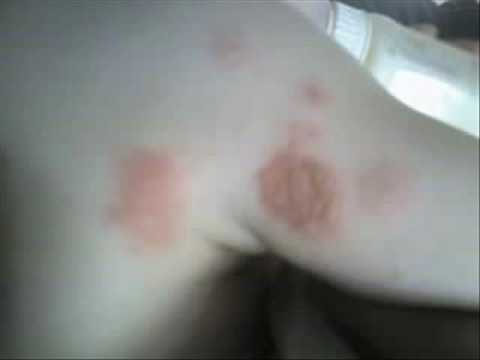 Dylan reaction after touching shell fish or nuts