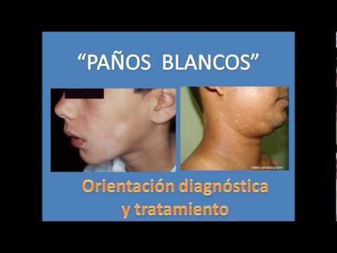 manchas en la piel - Se conoce, popularmente como PAÑOS BLANCOS, a una condición benigna de la piel caracterizada por la aparición de manchas blanquecina distribuidas en diferent...