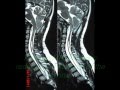 Back Deformity Due To Arnold-Chiari Malformation Back Deformity Due To Arnold-Chiari Malformation