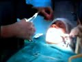 Cirurgia de resto radicular próximo ao seio maxilar- PARTE 2 Cirurgia de resto radicular próximo ao seio maxilar- PARTE 2