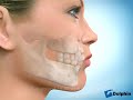 Removal of Four 1st Premolars to Reduce Crowding