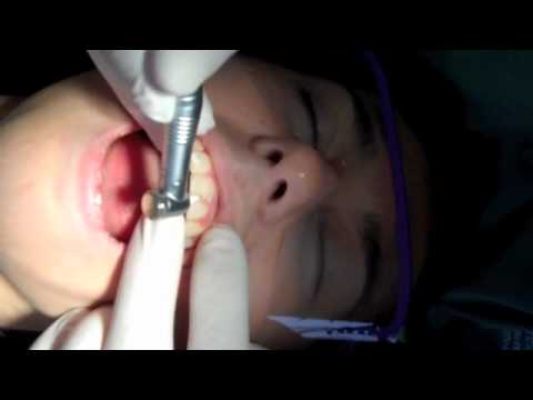 how to dissolve orthodontic cement