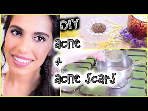 how to naturally get rid of acne