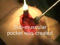 Augmentation mammaplasty ( teaching ) Prof. F. Alkhairy Cosmetic Surgery Centre Karachi Augmentation mammaplasty ( teaching ) Prof. F. Alkhairy Cosmetic Surgery Centre Karachi