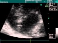 Aneurysm In Atrial Septum Aneurysm In Atrial Septum