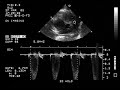 Pulmonary Stenosis