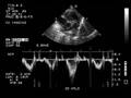 Pulmonary Stenosis