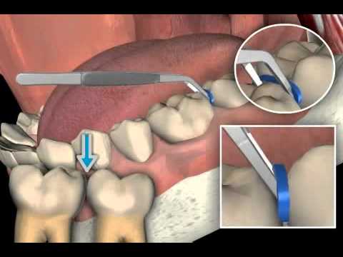 how to dissolve orthodontic cement