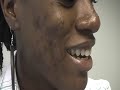 The Acne Practice  (severe case 3)