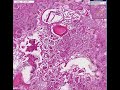 Histopathology Lung--Legionella pneumonia