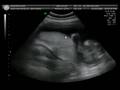 videos de Ultra-sonografia do Pedrinho